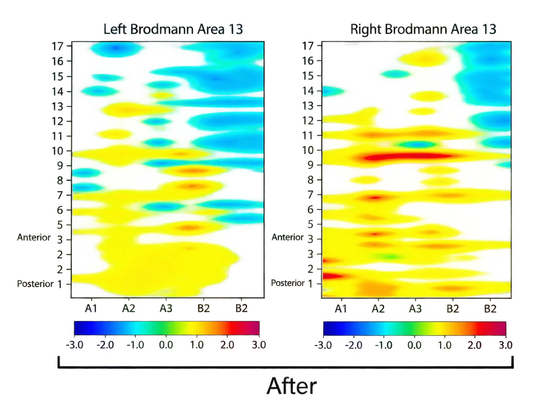 After: left and right Brodmann Area 13 brain-recording plots, with matching color scales from −3 to 3.