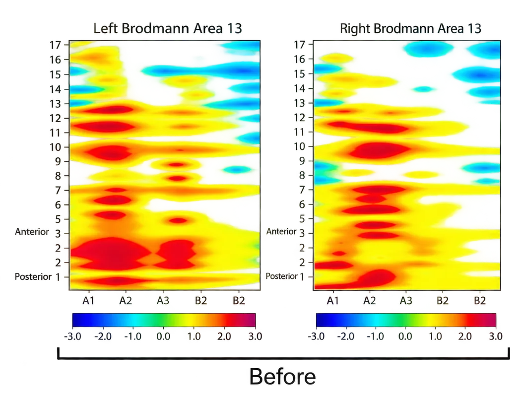 Before: left and right Brodmann Area 13 brain-recording plots, with matching color scales from −3 to 3.